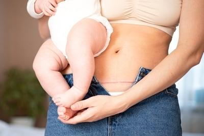 Mother-carry-baby-with-cearrean-mark-in-tummy.